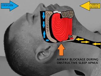 Sleeper Recliner For Sleep Apnea - Airway obstruction